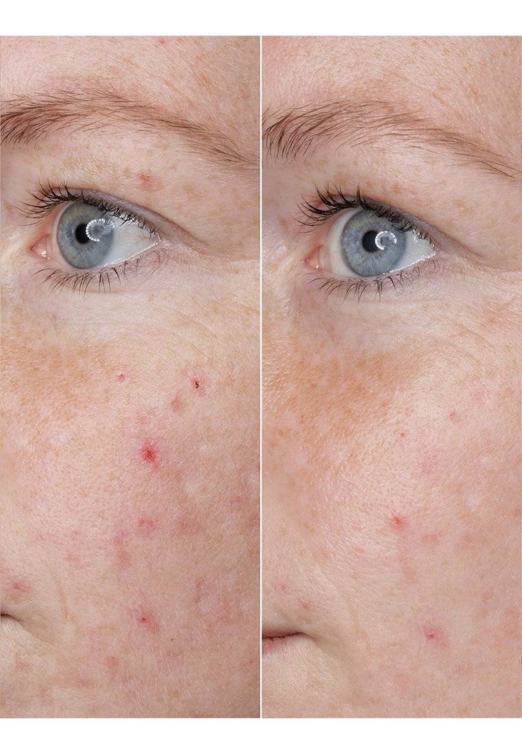 BABOR BABOR HYALURONIC ACID AMPOULE - Serum Auslauf